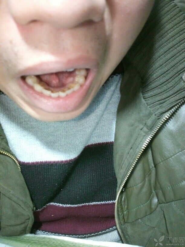 牙龈上有突起,摸上去硬