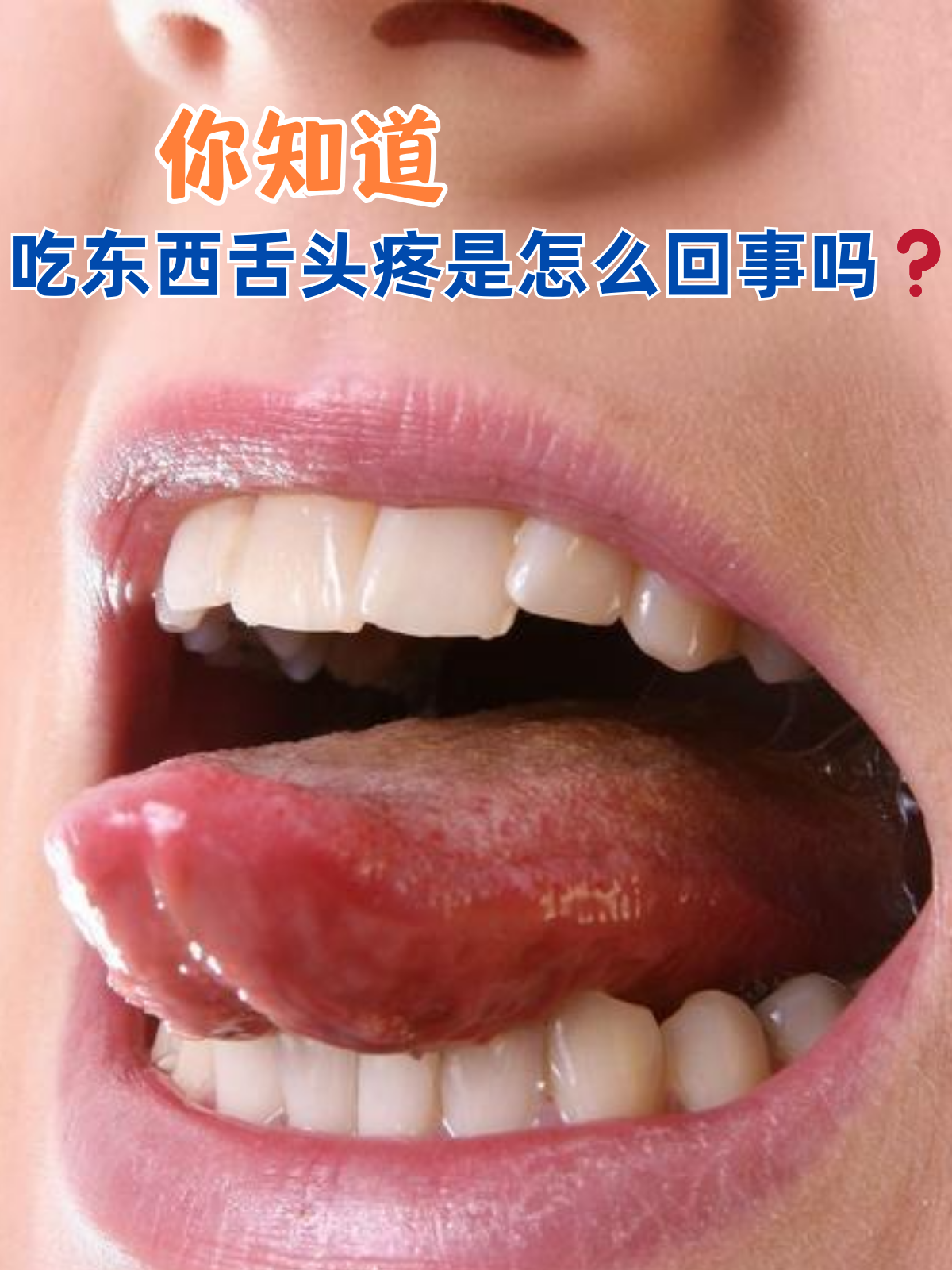 吃饭舌头咬坏了怎么办