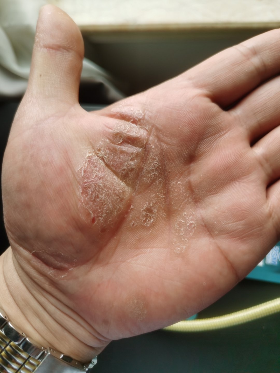 皮肌炎能彻底治愈吗?