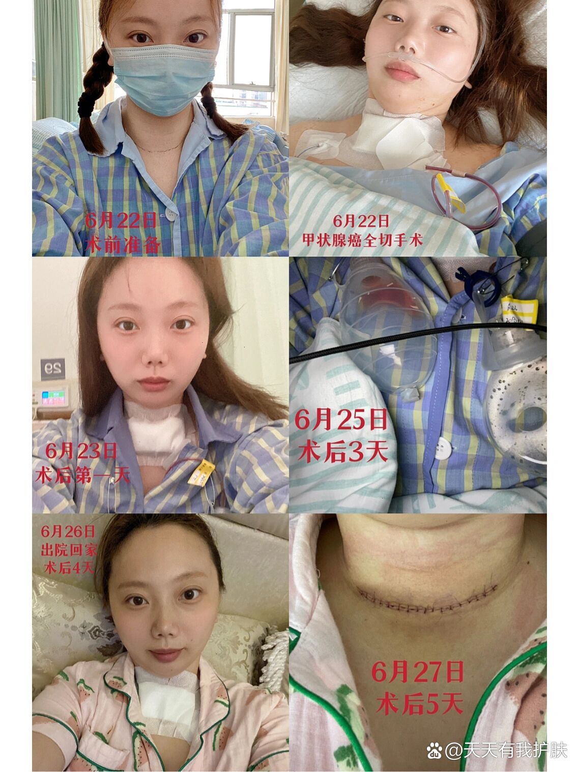 甲状腺癌术后多久能恢复