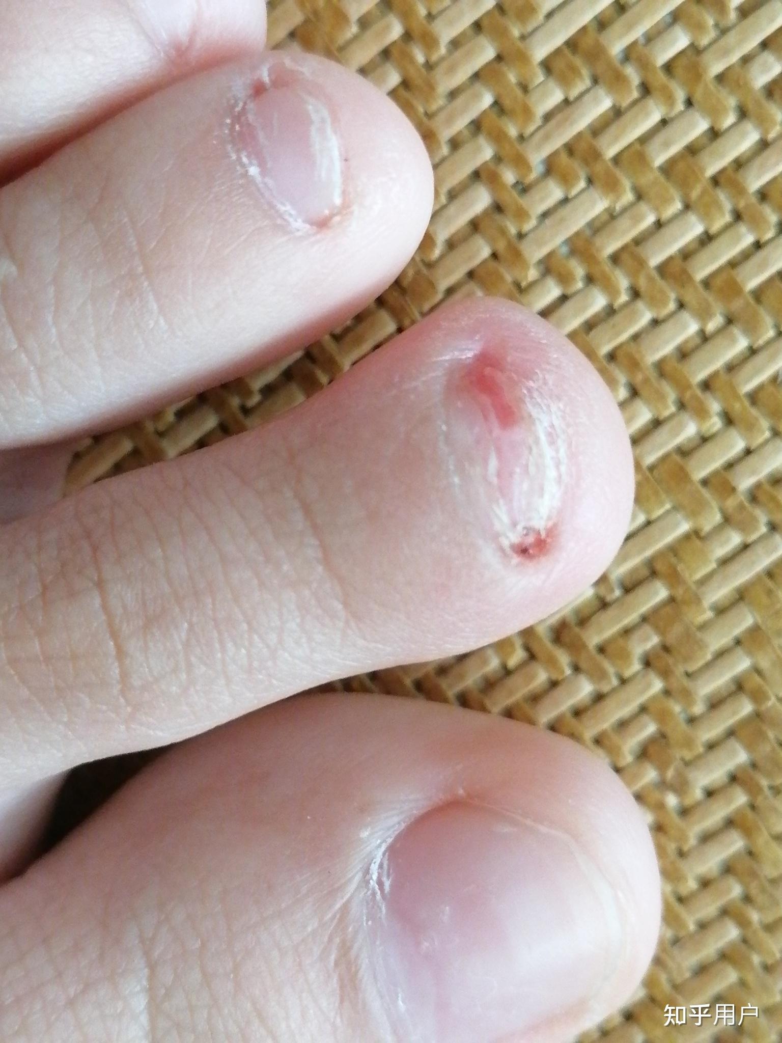 脚趾甲上有横纹是怎么回事