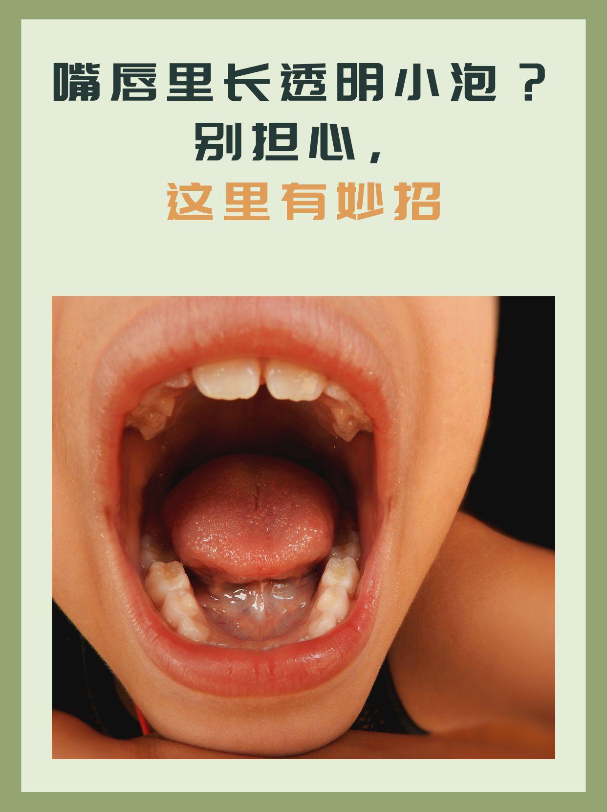 嘴巴里起泡怎么办