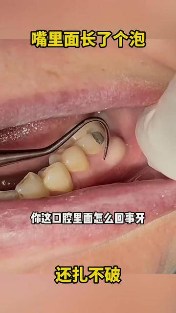 嘴巴里起泡怎么办