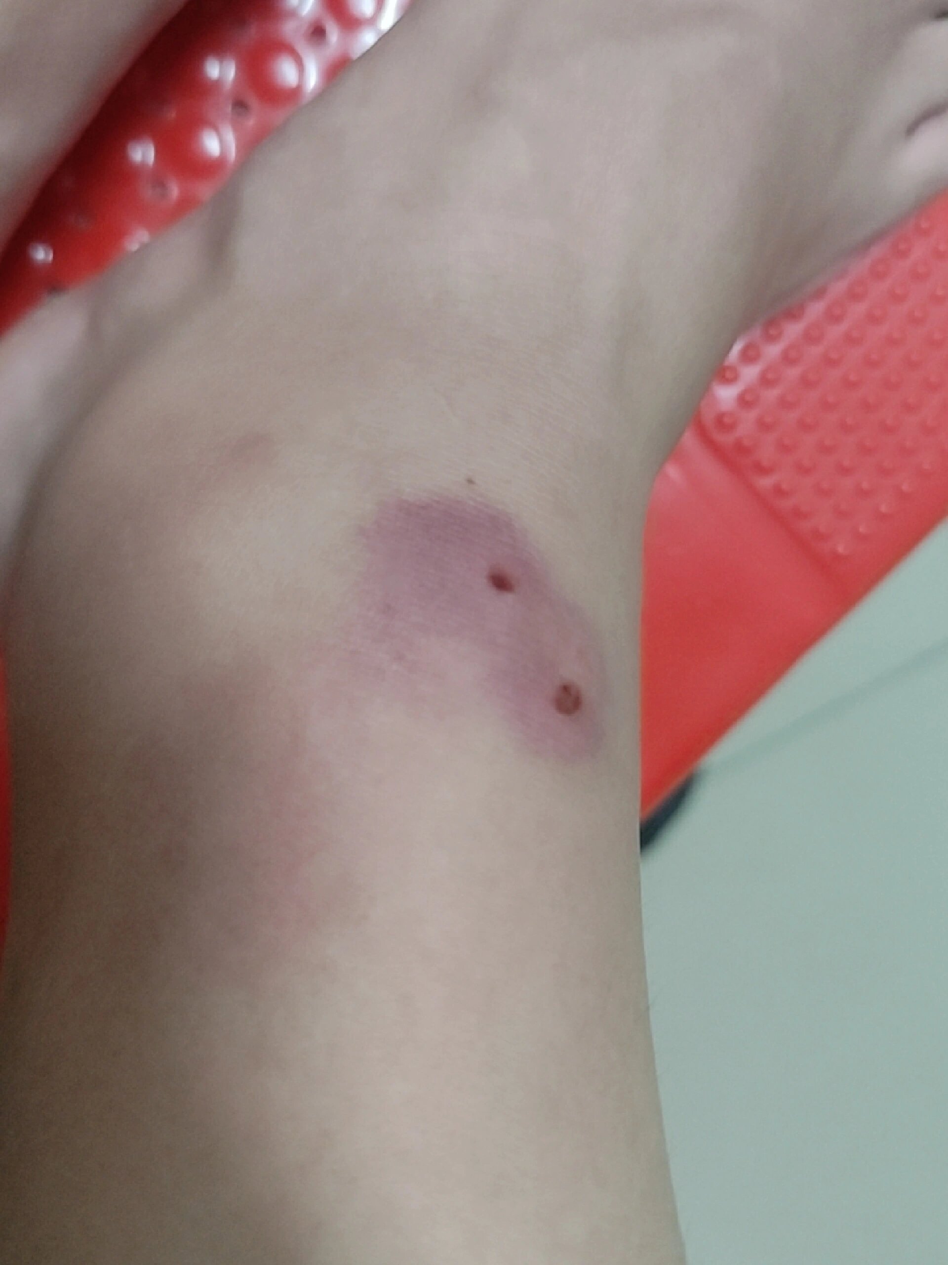 2016年被棉被里的臭虫咬过