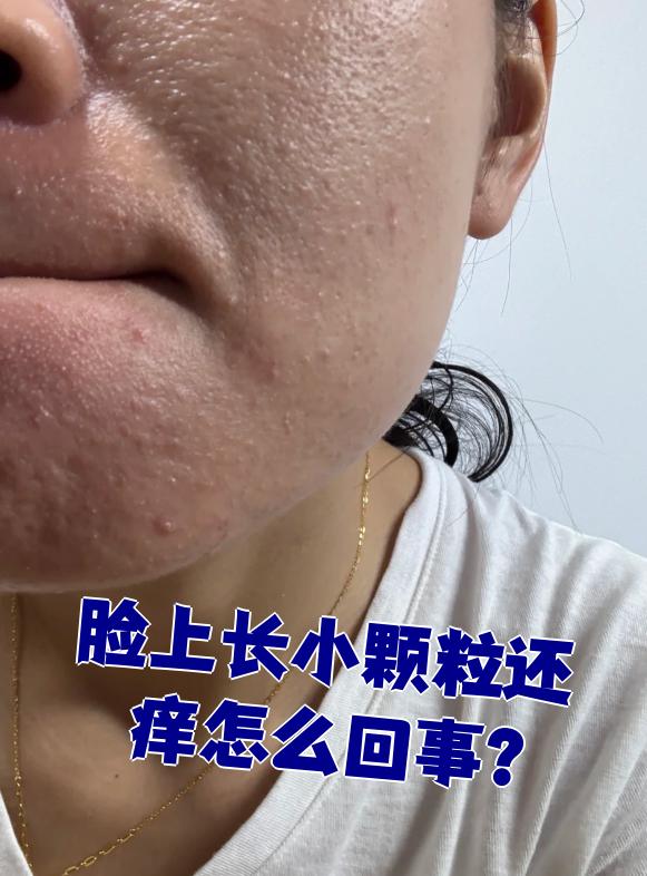 脸上有小肉粒怎么回事
