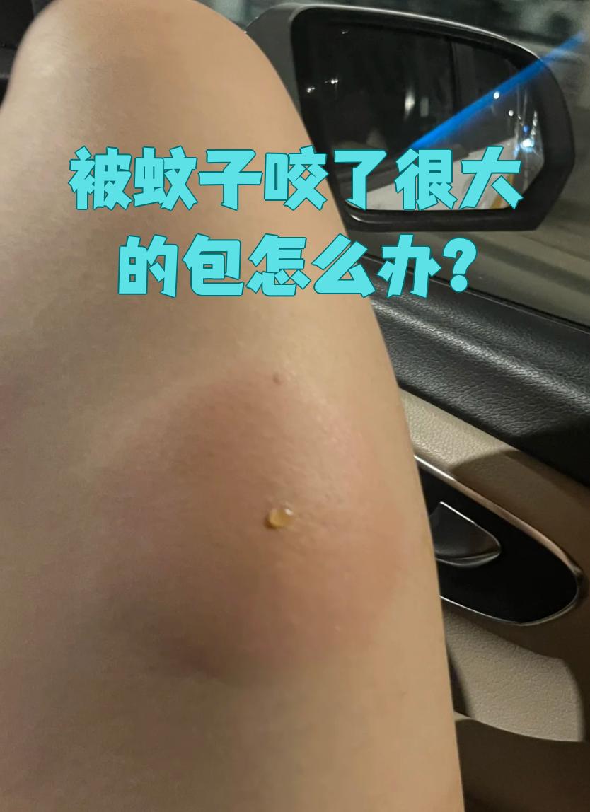 如何让蚊子咬的包快速消退,