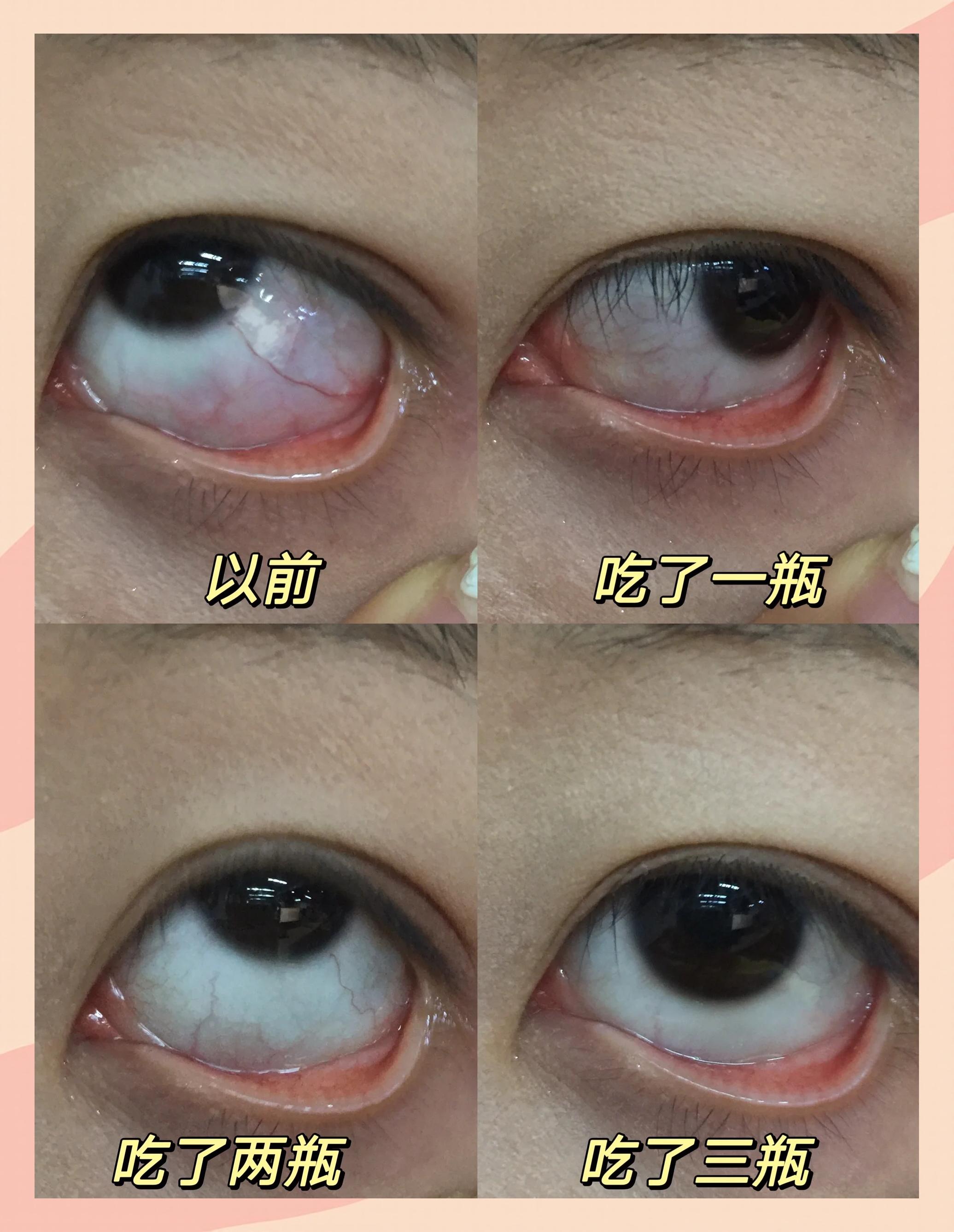 眼睛流血是什么情况