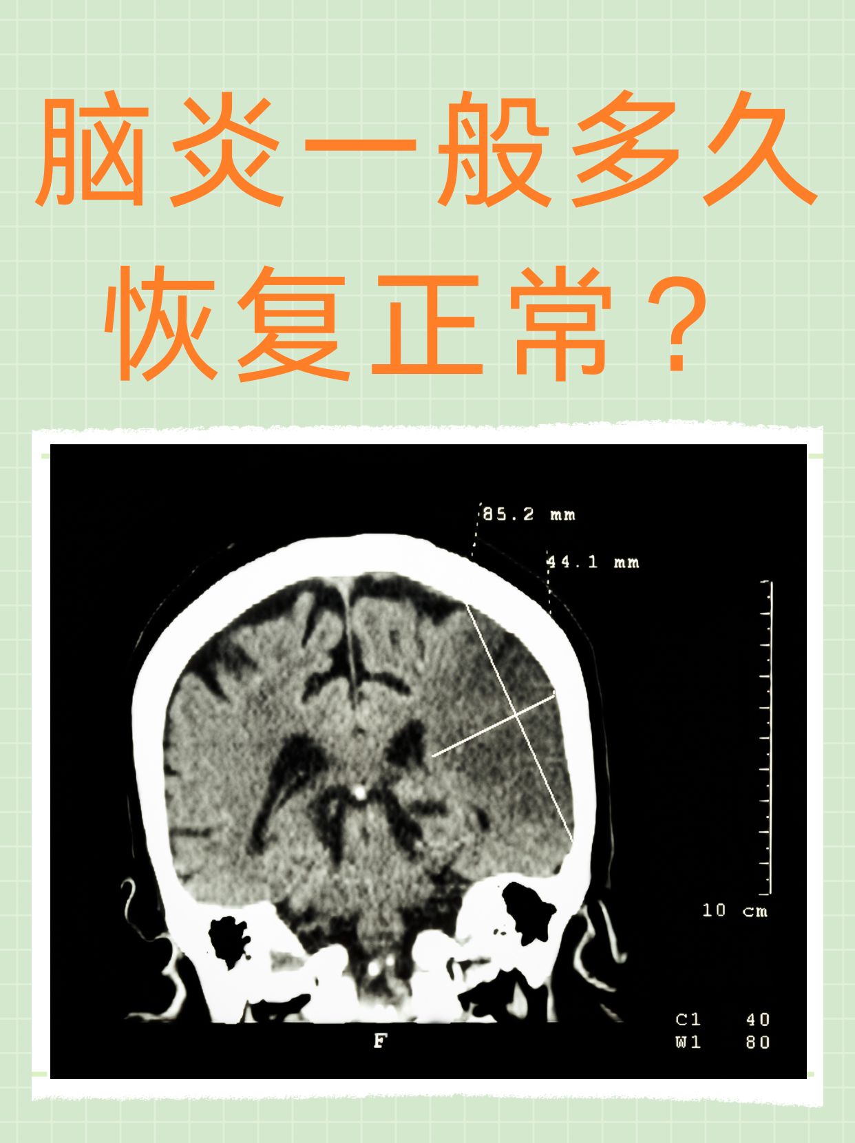 如何诊断是不是儿童脑炎
