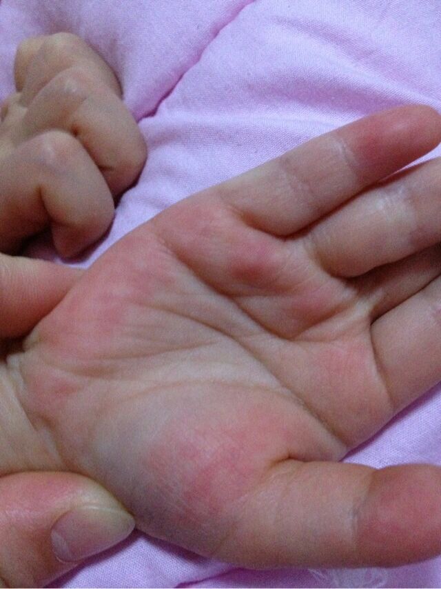 手心脚心发黄是怎么回事?