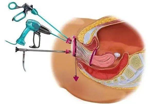 宫外孕微创手术怎么做