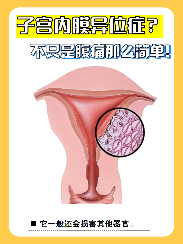 什么是子宫内膜