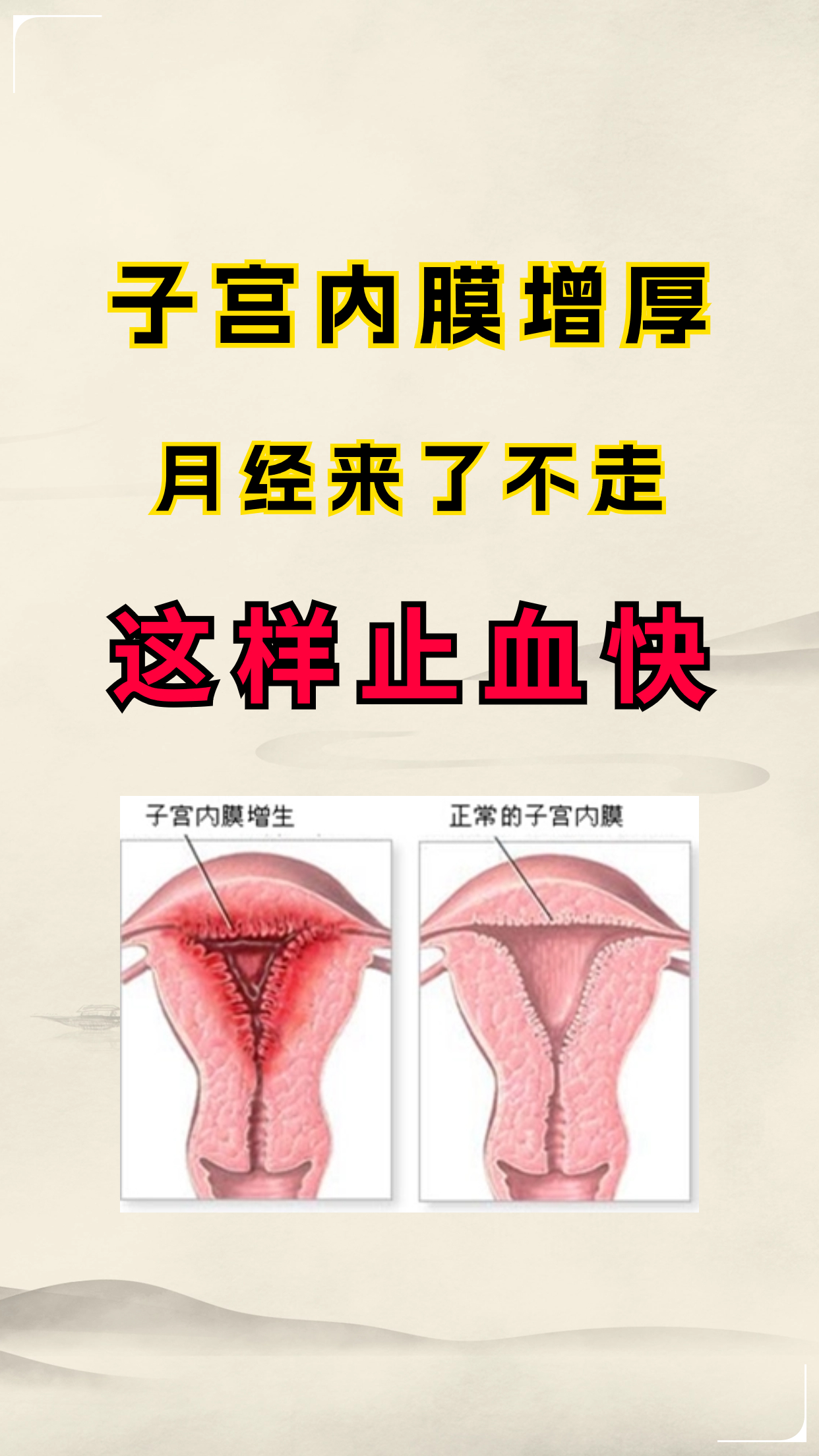 什么是子宫内膜