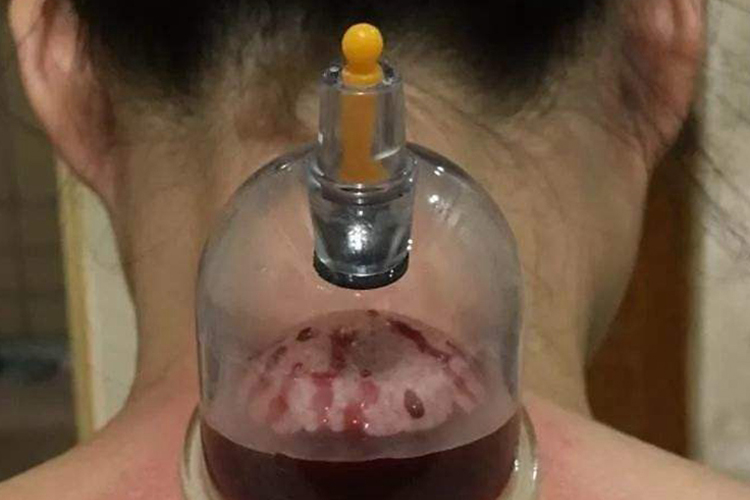 拔火罐可以治疗颈椎病吗