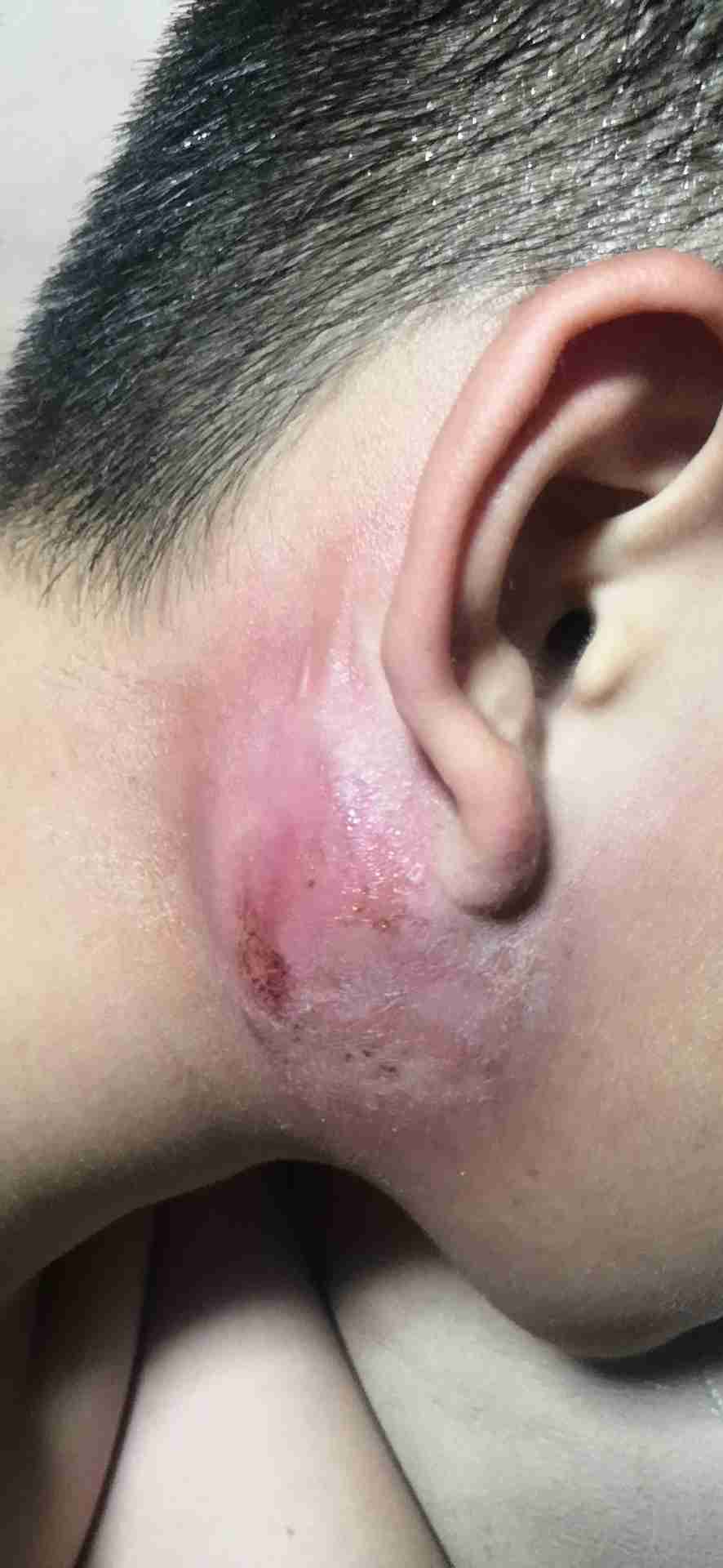 耳朵后面起脓包是什么病