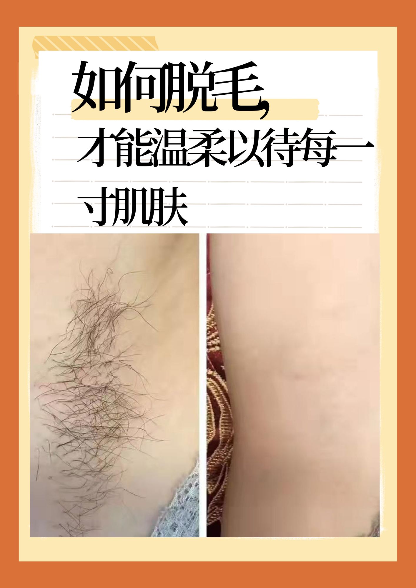 冰点脱毛时永久的吗?