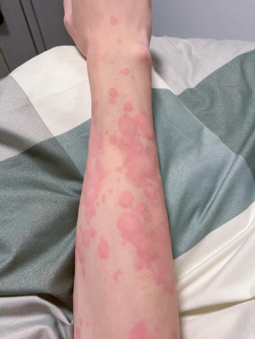 一到夏天身上起红疙瘩怎么办?