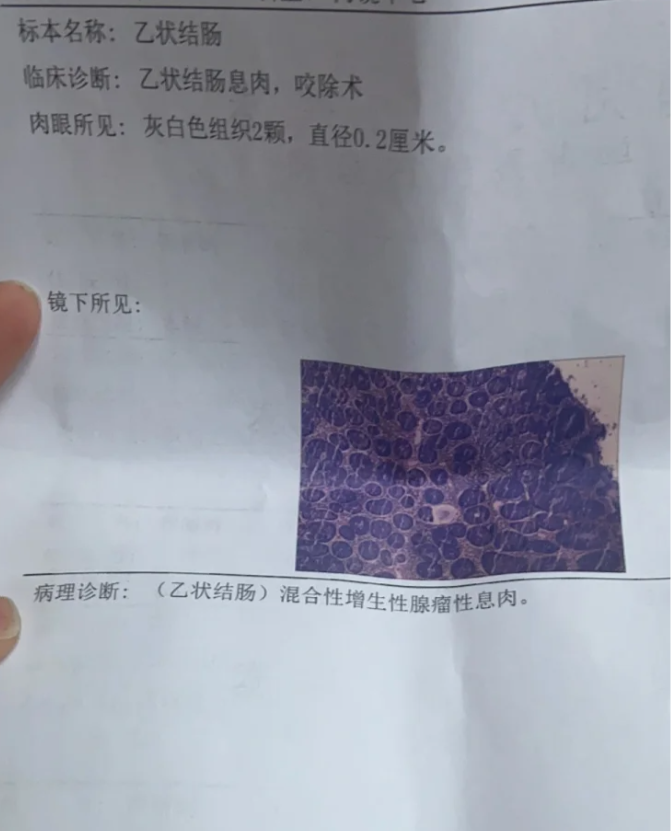 胃息肉切除后还会长吗