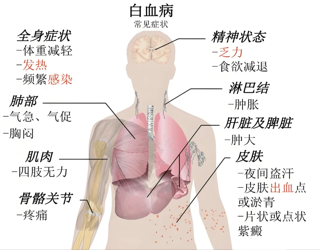 白血病起因和症状