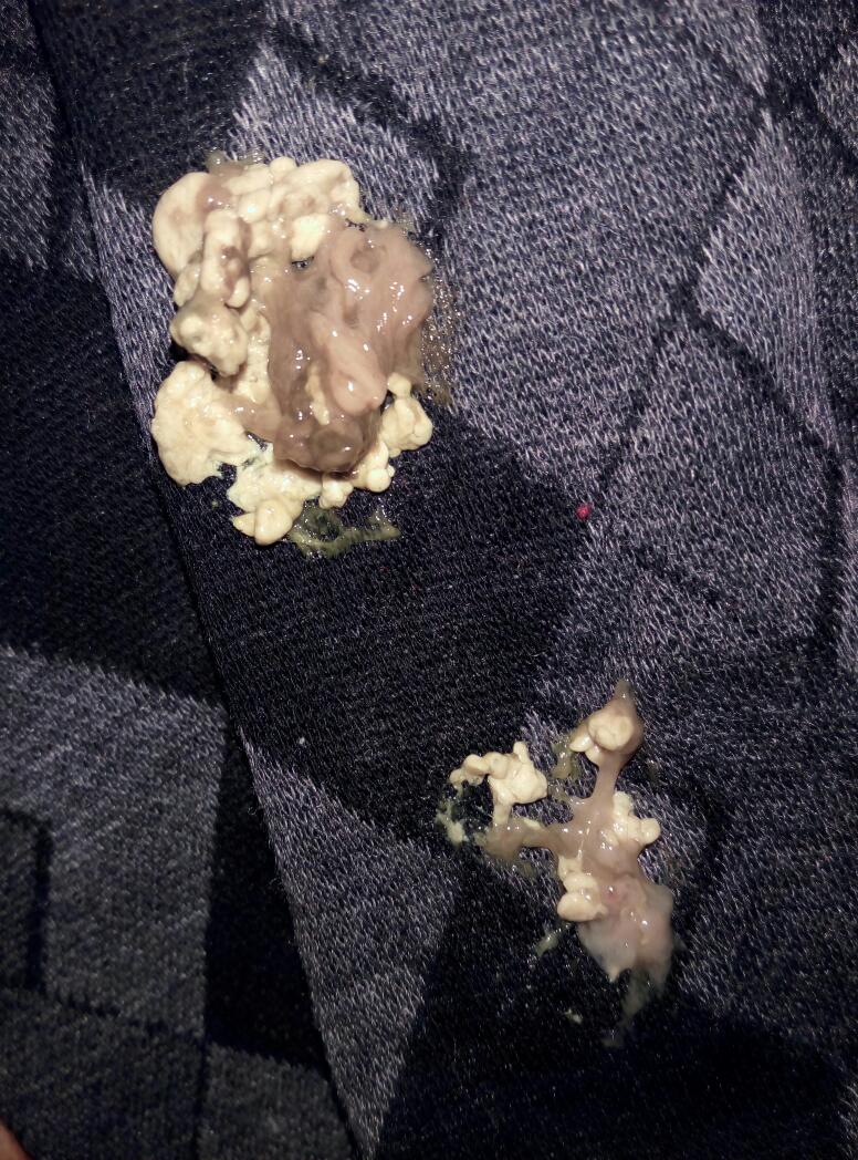 大便黑色且稀是怎么回事