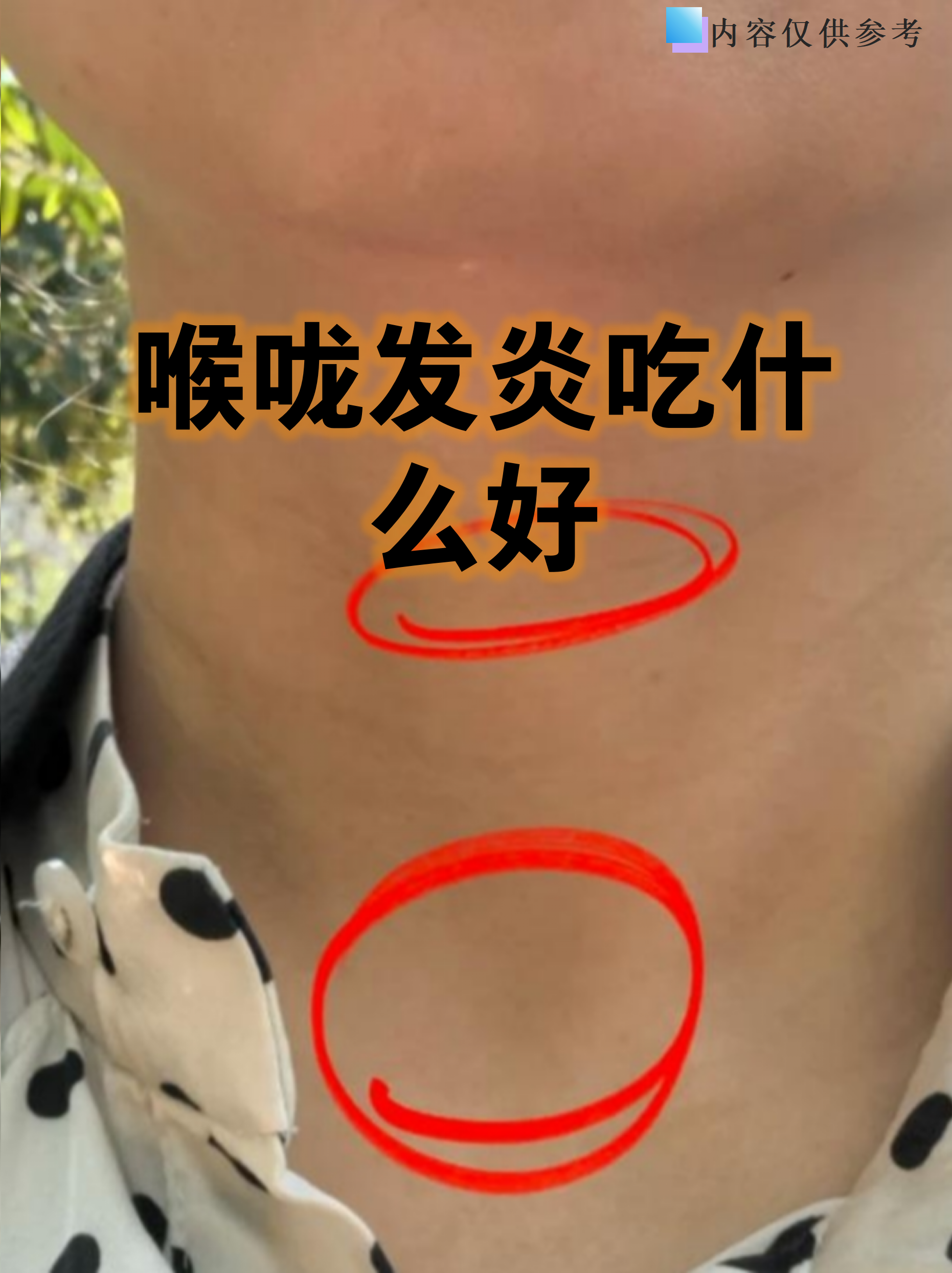 扁桃体化脓禁忌吃什么