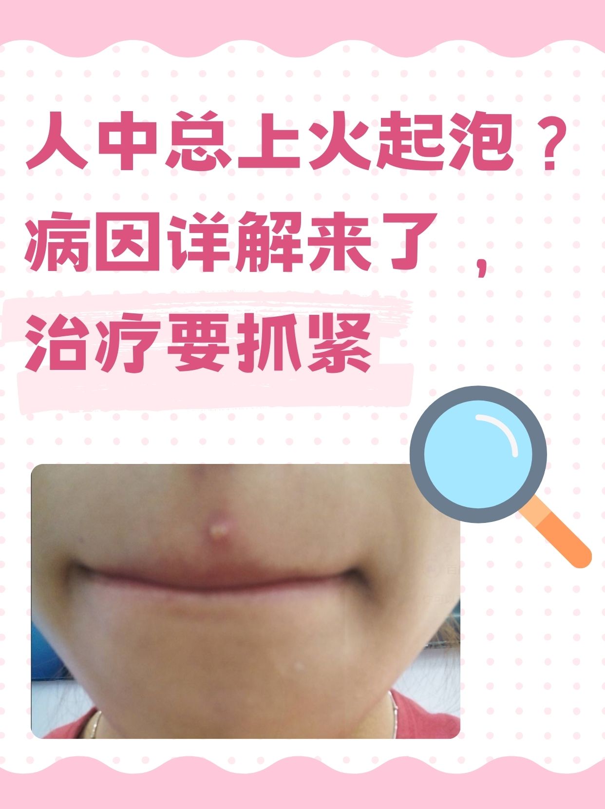 上火鼻子下面起泡泡