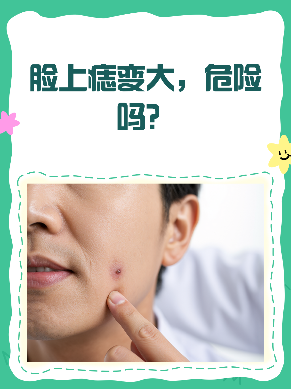 脸上痣为什么会越来越多