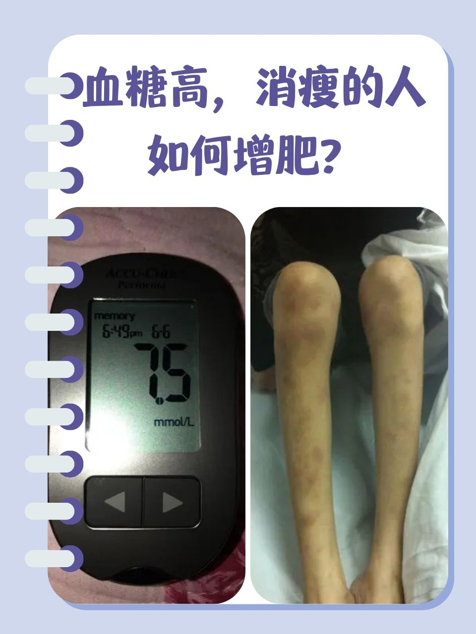 为什么糖尿病人会瘦