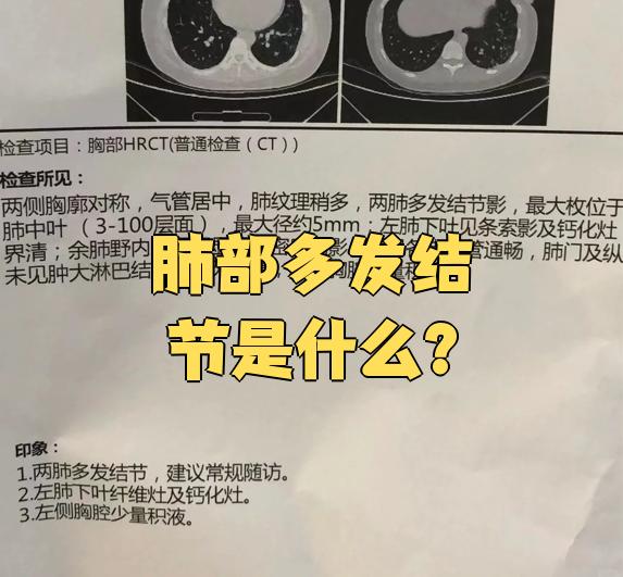 肺部结节是什么