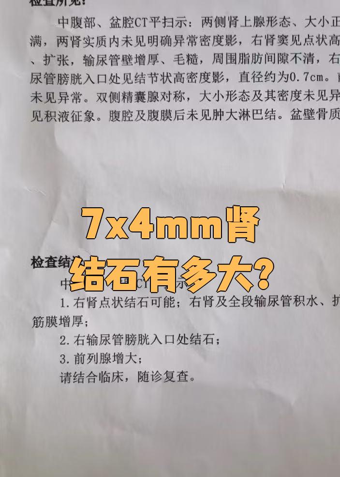 肾结石体外碎石费用大概有多少