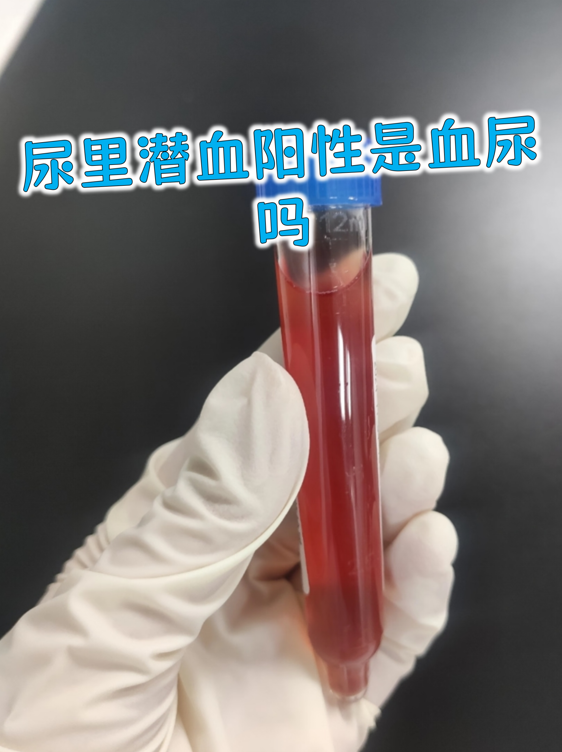 女性无痛血尿就是癌吗