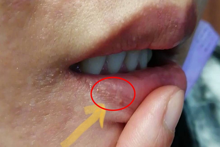 嘴唇长一粒粒白色点是怎么回事