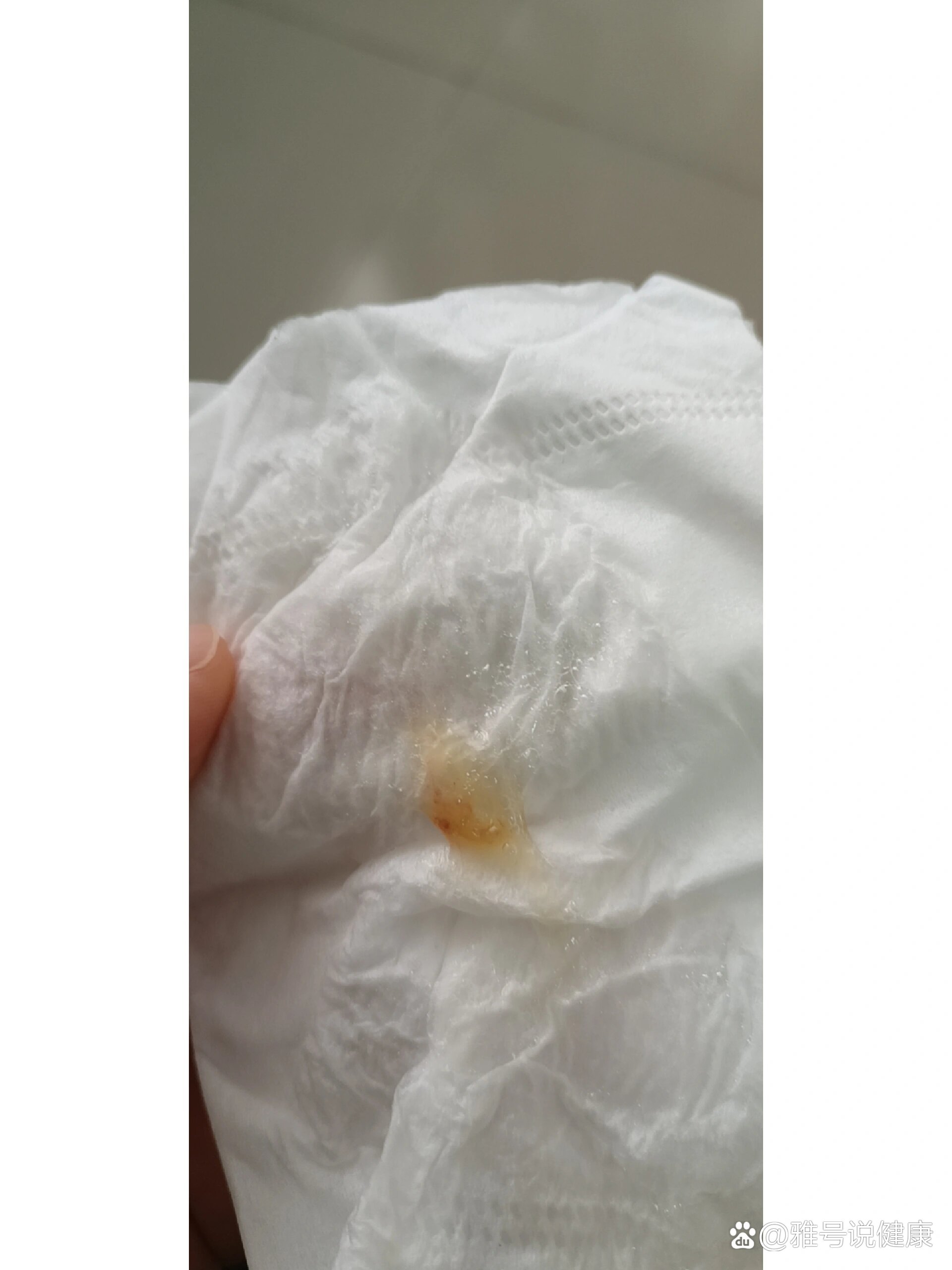 慢性咽炎痰中会有血吗