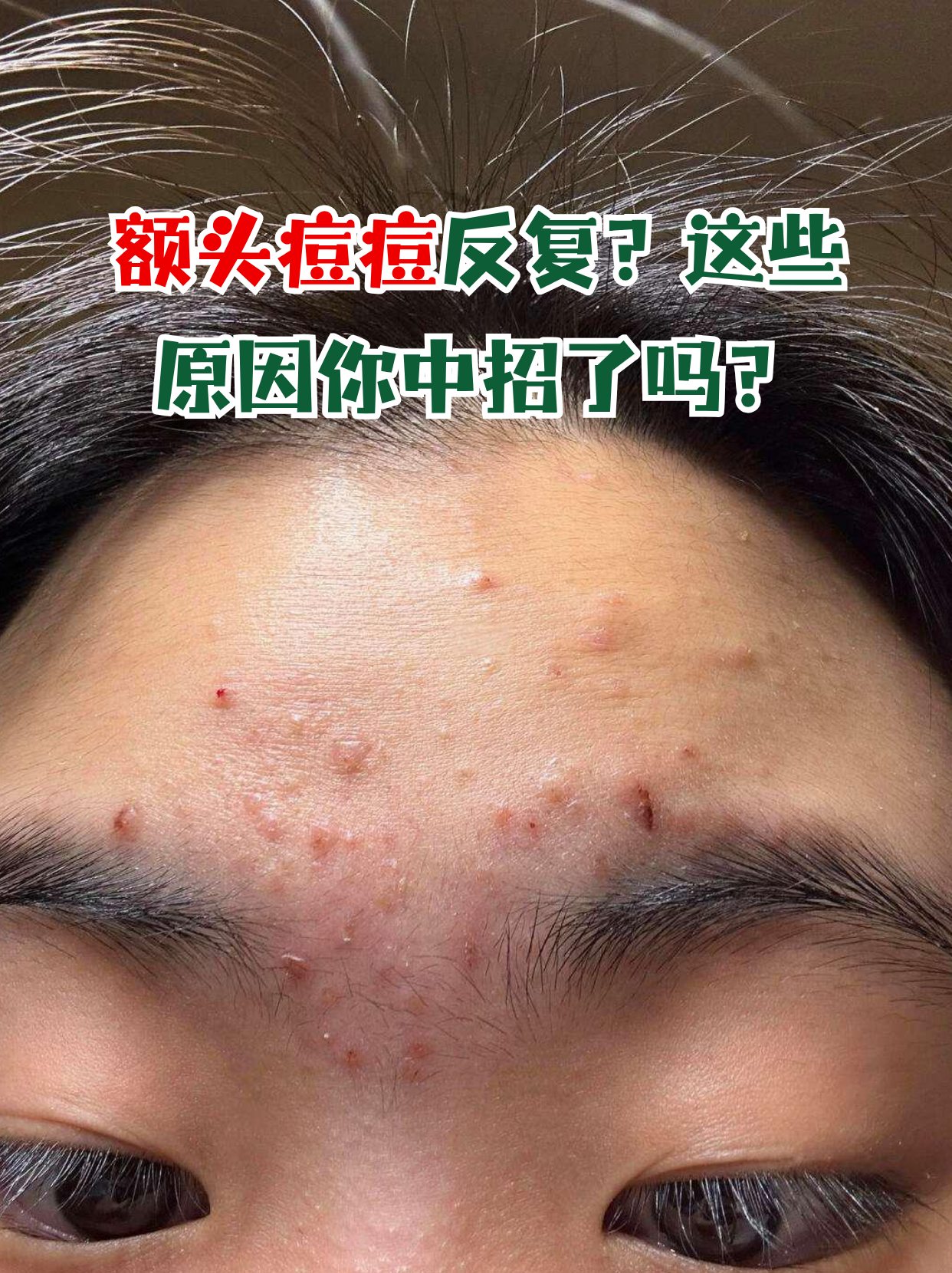 额头总是反复长痘痘怎么办?