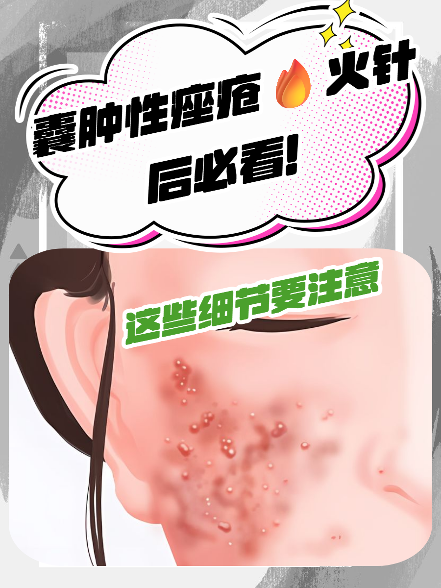 囊肿型痤疮会自愈吗