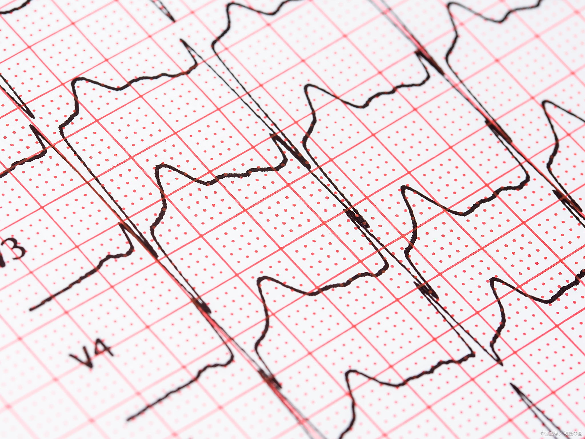 窦房结内游走心律是什么意思
