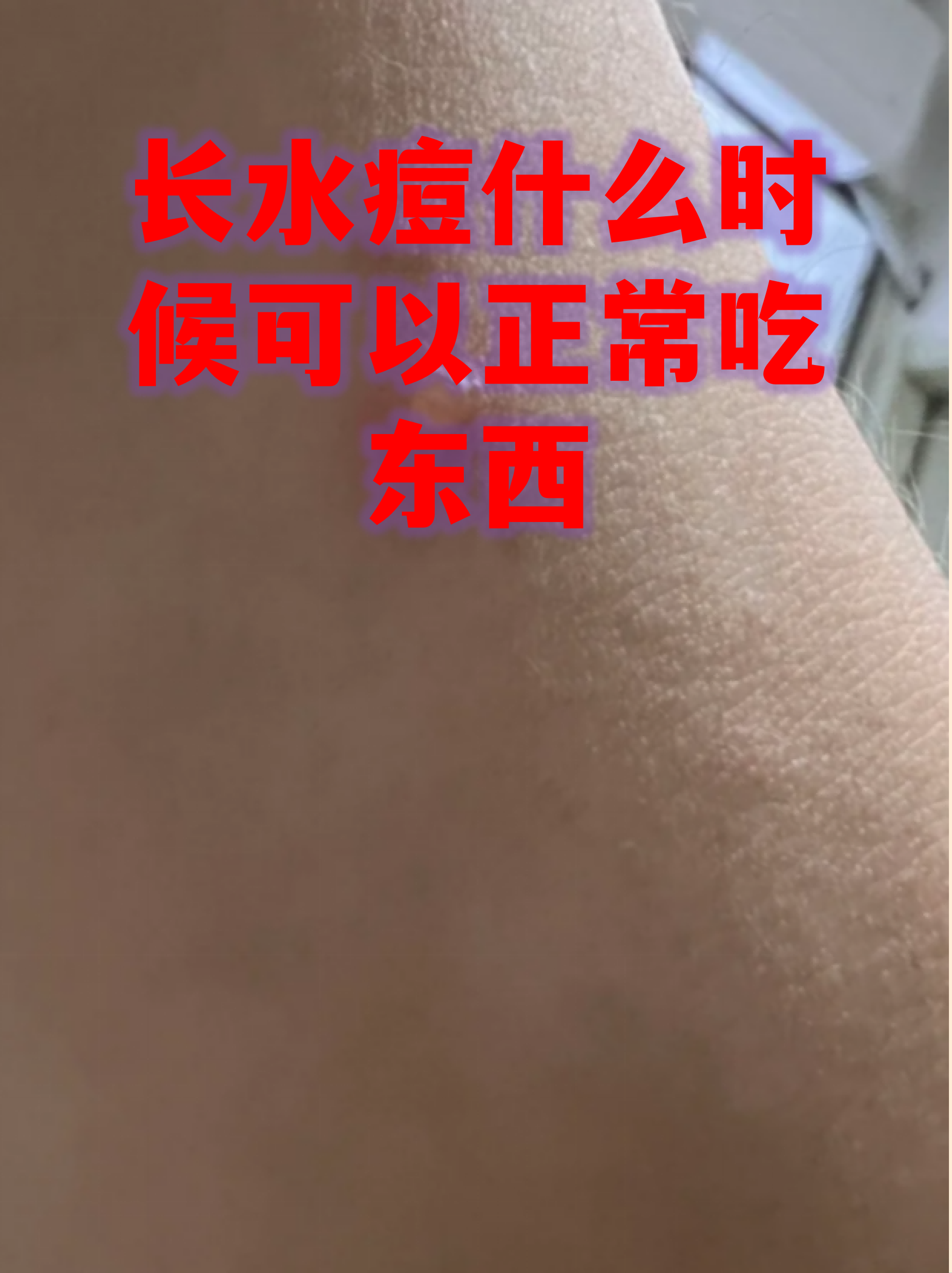 水痘到结的痂完全脱落要多久