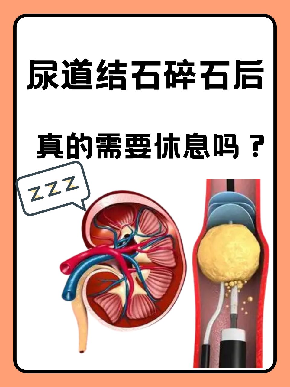 尿结石排出预兆和感觉是什么