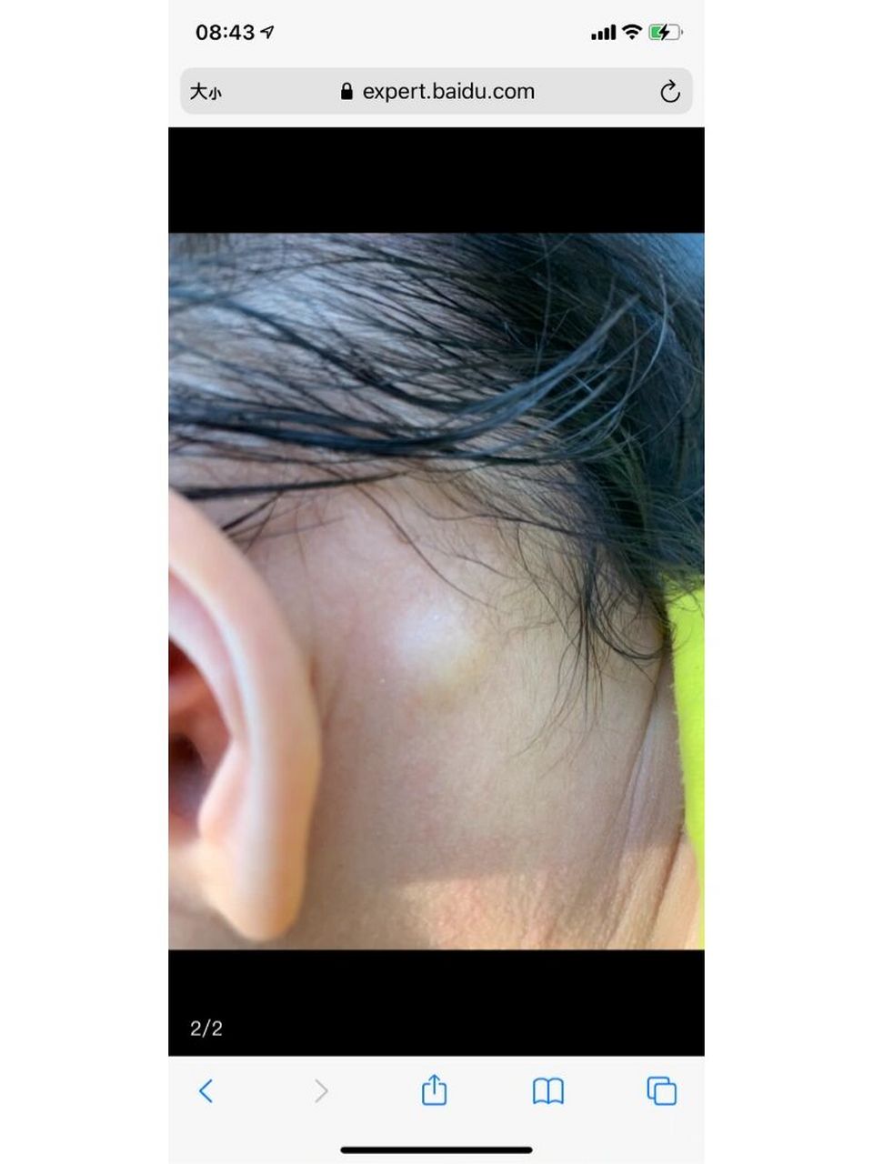 耳朵后面长个硬包.按还疼