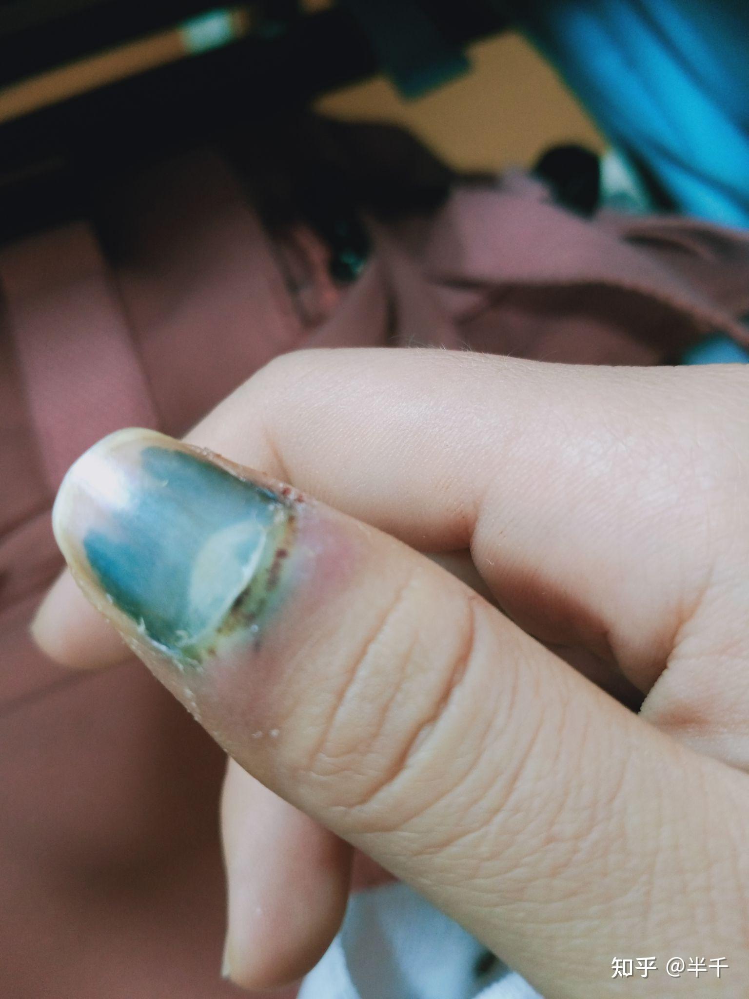 手指甲被门夹了有淤血发黑