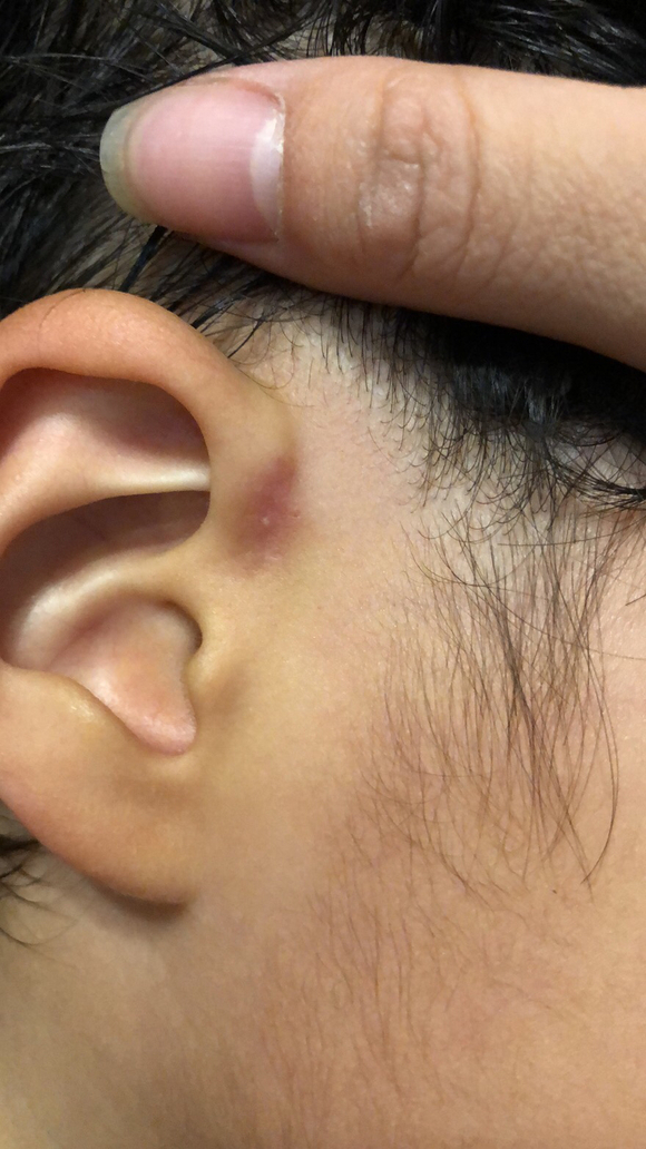 耳前瘘管术后依然有疼感