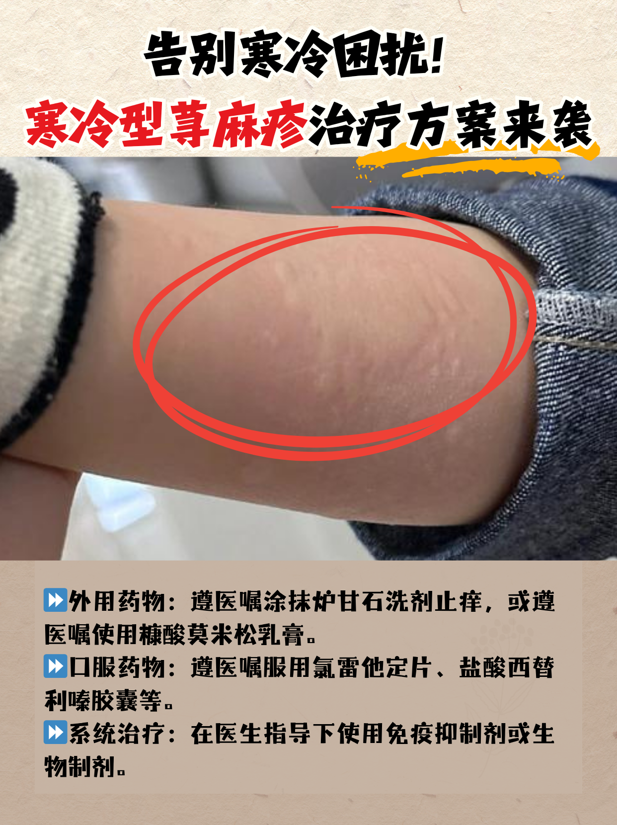 过敏性荨麻疹多久能治好