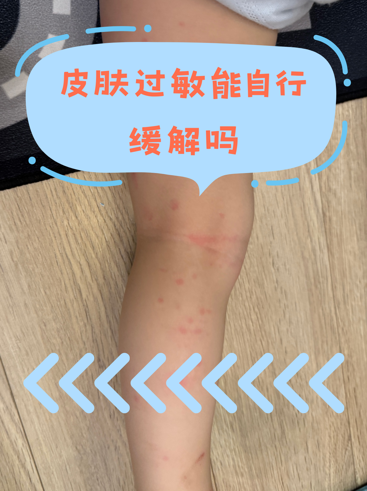 过敏性荨麻疹多久能治好