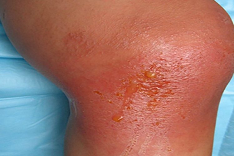 膝盖破皮有黄水怎么办