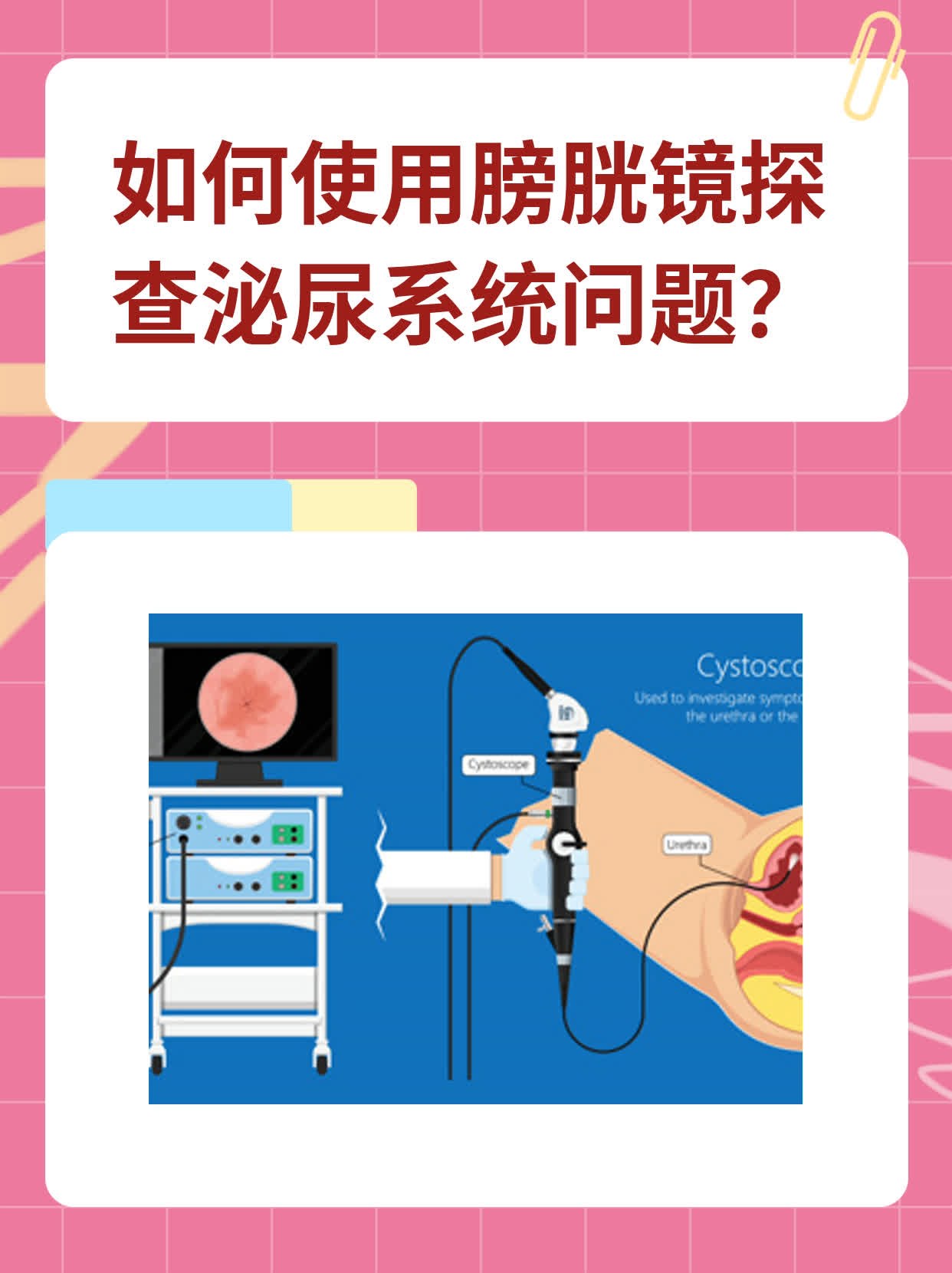 膀胱镜检查难受吗