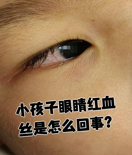 宝宝眼睛有红血丝是什么原因