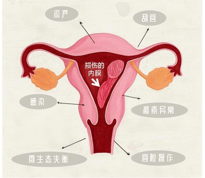 人流后粘连症状