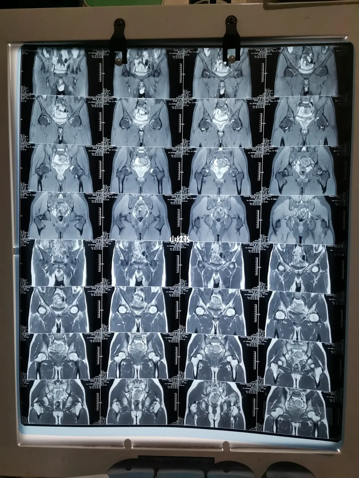 髋关节积液会自愈吗