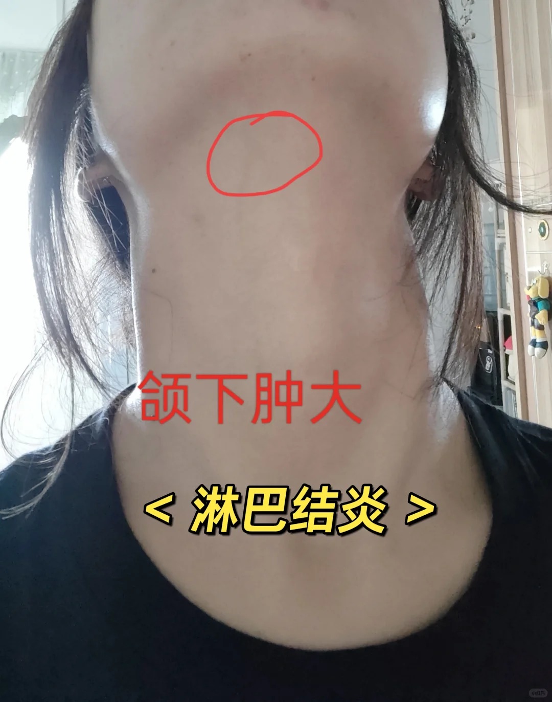 上火会导致淋巴结肿大吗?..