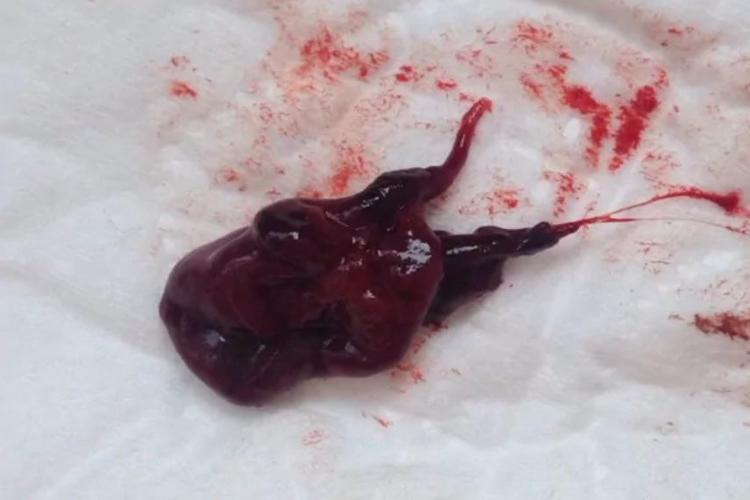 怀孕初期流产的征兆