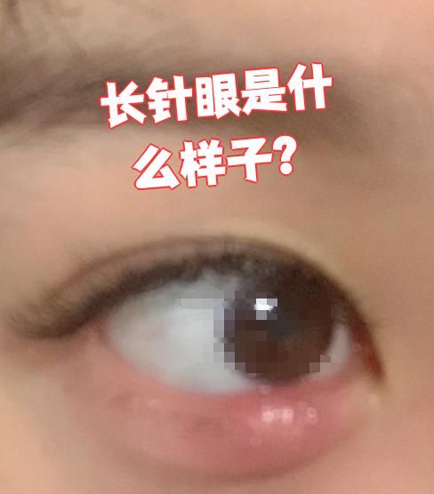 针眼一般几天能好